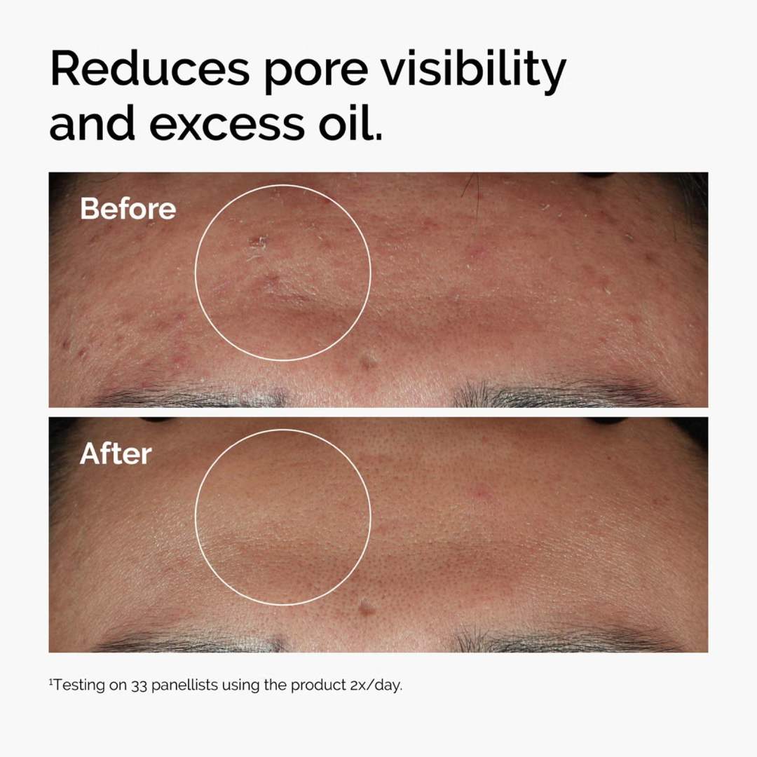 THE ORDINARY - Niacinamide 10% + Zinc 1% Oil Control Serum - 30ml - Image 5